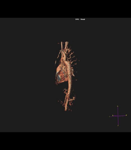 File:Coarctation of the aorta (Radiopaedia 43373-46729 3D reconstruction 12).jpg