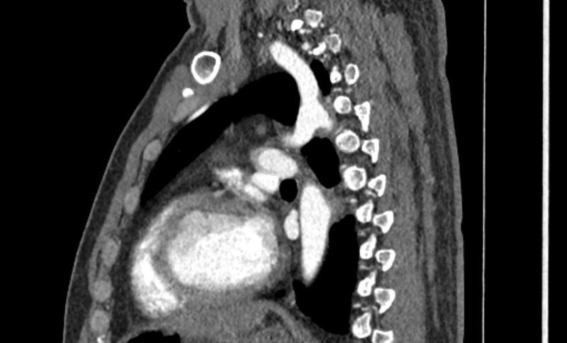 File:Coarctation of the aorta (Radiopaedia 53363-59343 B 40).jpg