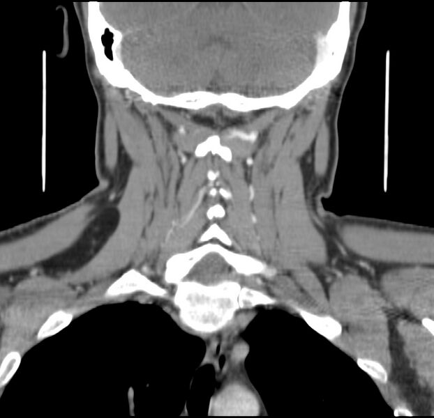 File:Colloid cyst of thyroid (Radiopaedia 22897-22923 Coronal C+ delayed 44).jpg