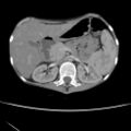 Colocolic fistula - Crohn disease (Radiopaedia 57063-63955 A 22).jpg