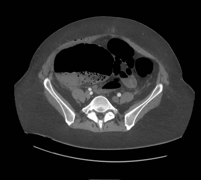 File:Colonic pseudo-obstruction (Radiopaedia 79752-92980 A 133).png