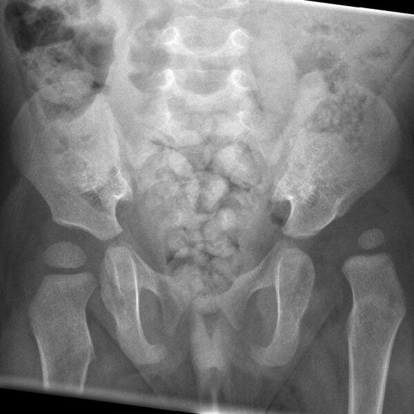 File:Developmental dysplasia of the hip (Radiopaedia 7978).jpg