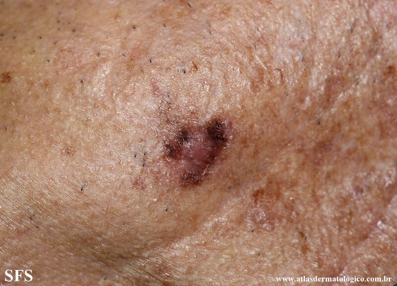 File:Melanoma (Dermatology Atlas 125).jpg