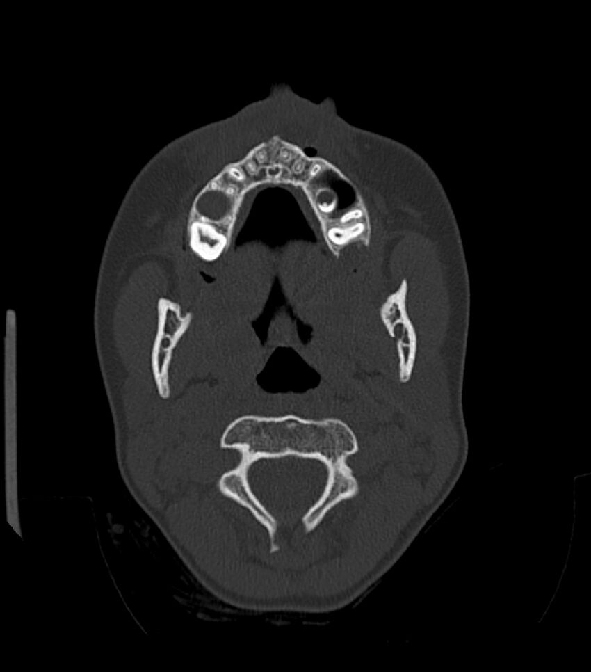 Nasoorbitoethmoid fracture (Radiopaedia 90044-107205 Axial bone window 47).jpg