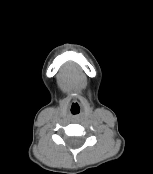 File:Nasoorbitoethmoid fracture (Radiopaedia 90044-107205 Axial non-contrast 34).jpg