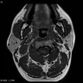 Nasopharyngeal carcinoma (Radiopaedia 4546-6667 Axial T1 14).jpg