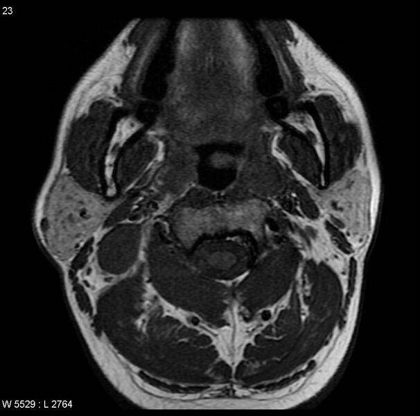 File:Nasopharyngeal carcinoma (Radiopaedia 4546-6667 Axial T1 14).jpg