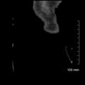Neonatal neuroblastoma (Radiopaedia 56651-63438 Coronal non-contrast 50).jpg