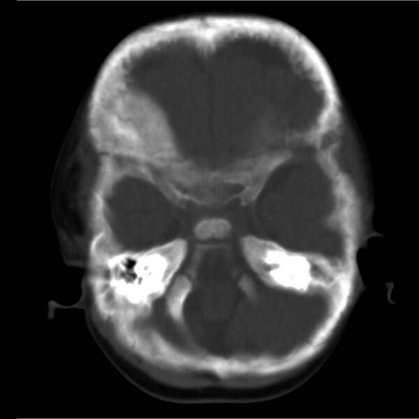 File:Neuroblastoma with skull metastases (Radiopaedia 30326-30958 Axial bone window 3).jpg