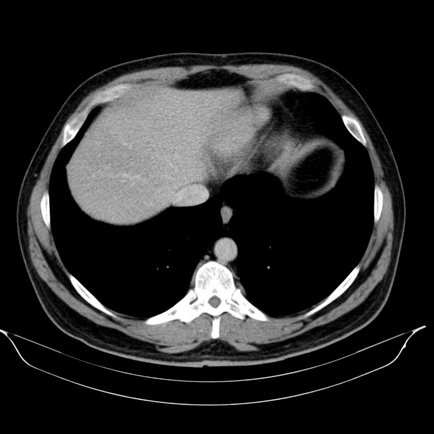 Neuroendocrine tumor of head of pancreas (Radiopaedia 57538-64502 D 11).jpg