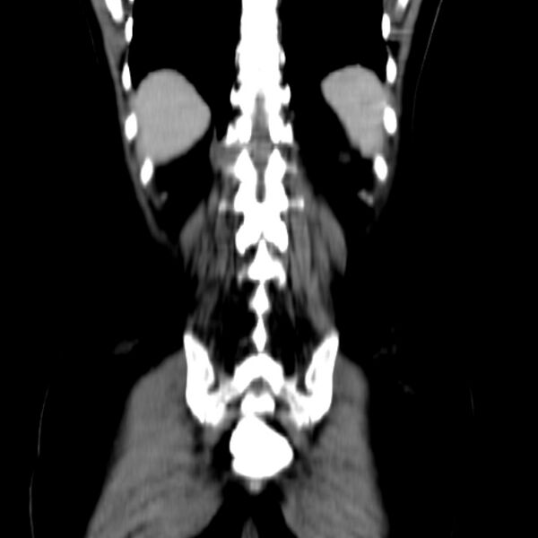 File:Neurofibroma - spine (Radiopaedia 27891-28125 B 26).jpg