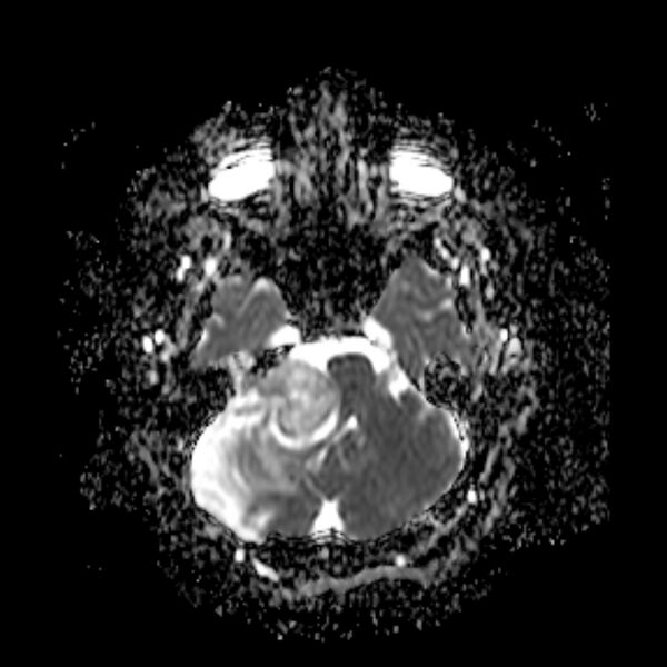 File:Neurofibromatosis type 2 (Radiopaedia 67470-76871 Axial ADC 6).jpg