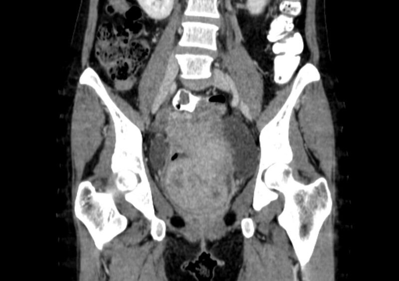 File:Non-puerperal uterine inversion (Radiopaedia 78343-91094 B 9).jpg