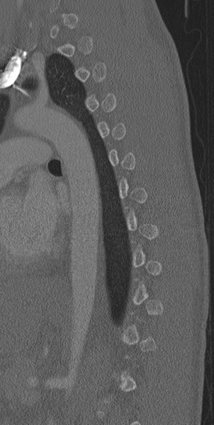File:Normal CT thoracic spine (Radiopaedia 40181-42688 Sagittal bone window 19).png