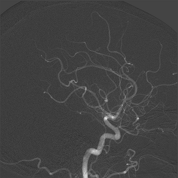 File:Normal cerebral angiogram (four vessel DSA) (Radiopaedia 41708-44649 F 8).png