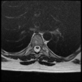 Normal cervical and thoracic spine MRI (Radiopaedia 35630-37156 H 26).png