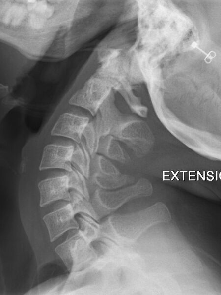 File:Normal flexion and extension cervical spine x-rays (Radiopaedia 37967-39909 Lateral 1).jpg