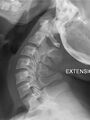 Normal flexion and extension cervical spine x-rays (Radiopaedia 37967-39909 Lateral 1).jpg