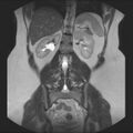 Normal liver MRI with Gadolinium (Radiopaedia 58913-66163 Coronal T2 28).jpg