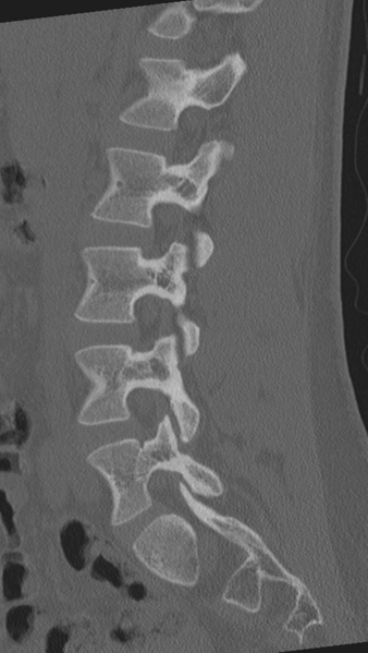 File:Normal lumbar spine CT (Radiopaedia 46533-50986 Sagittal bone window 62).png