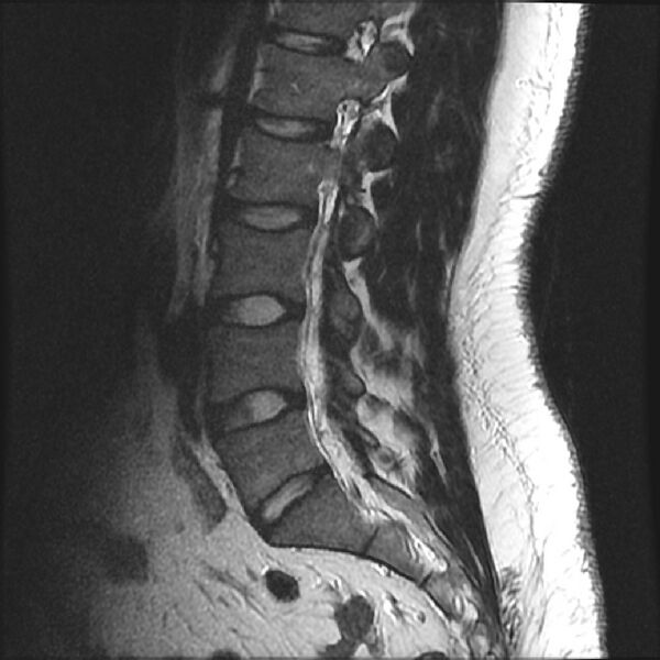File:Normal lumbar spine MRI (Radiopaedia 43051-46311 Sagittal T2 13).jpg