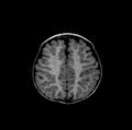 Normal myelination 19 month old (Radiopaedia 6813-7981 Axial T1 3).jpg