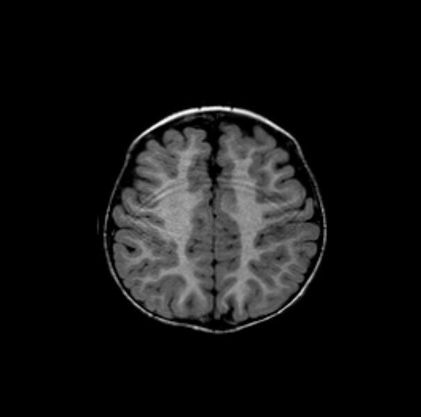 File:Normal myelination 19 month old (Radiopaedia 6813-7981 Axial T1 3).jpg