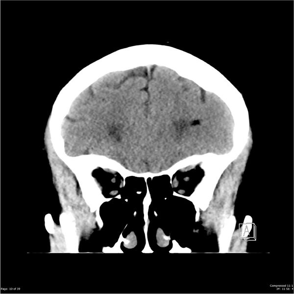 File:Normal pressure hydrocephalus (Radiopaedia 24415-24736 Coronal non-contrast 6).jpg