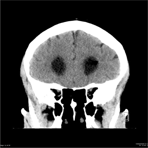 File:Normal pressure hydrocephalus (Radiopaedia 24415-24736 Coronal non-contrast 7).jpg