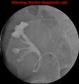 Normal retrograde pyelography of a native and transplant kidney (Radiopaedia 40480-43054 Transplant kidney 10).jpg