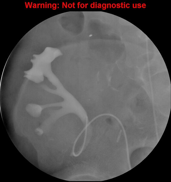 File:Normal retrograde pyelography of a native and transplant kidney (Radiopaedia 40480-43054 Transplant kidney 10).jpg