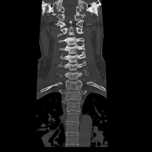 File:Occipital condyle fracture (Radiopaedia 31755-32691 Coronal bone window 14).jpg