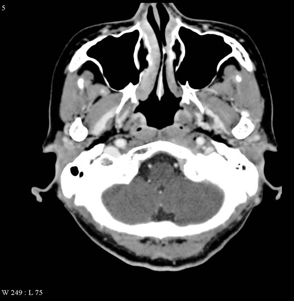 File:Occipital condyle metastasis - into mastoid (Radiopaedia 5424-7177 B 5).jpg