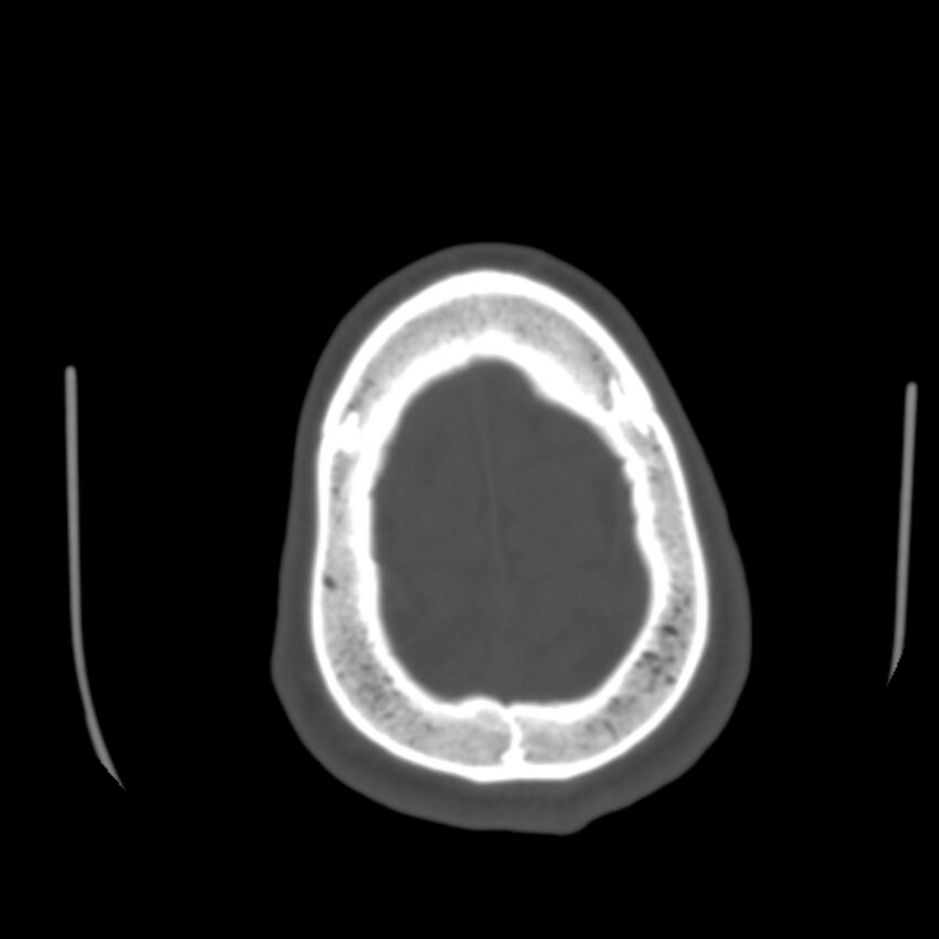 Occipital spur - asymptomatic (Radiopaedia 87753-104201 Axial bone window 192).jpg