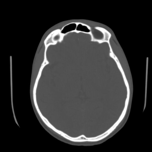 File:Occipital spur - asymptomatic (Radiopaedia 87753-104201 Axial bone window 94).jpg