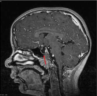 Empty sella- MRI Scan of the brain, sagittal T2-weighted