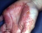 Zoophilic tinea infection (DermNet NZ tinea-manuum-01).jpg