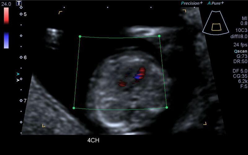 File:1st trimester nuchal-morphology ultrasound (Radiopaedia 44706-48477 Heart views cine with colour 32).jpg