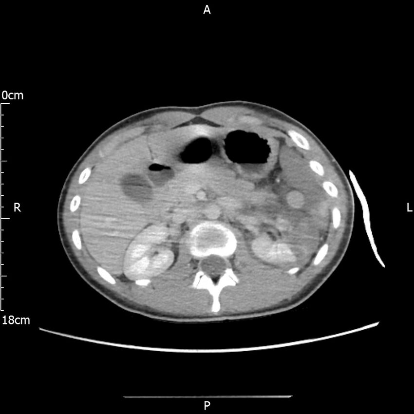 AAST grade IV kidney injury with CEUS follow-up (Radiopaedia 72353-82877 Axial C+ portal venous phase 23).jpg