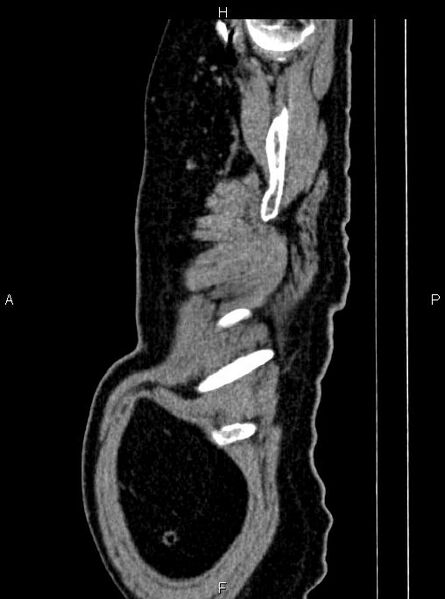 File:Abdominal aortic aneurysm (Radiopaedia 83094-97462 Sagittal renal cortical phase 10).jpg