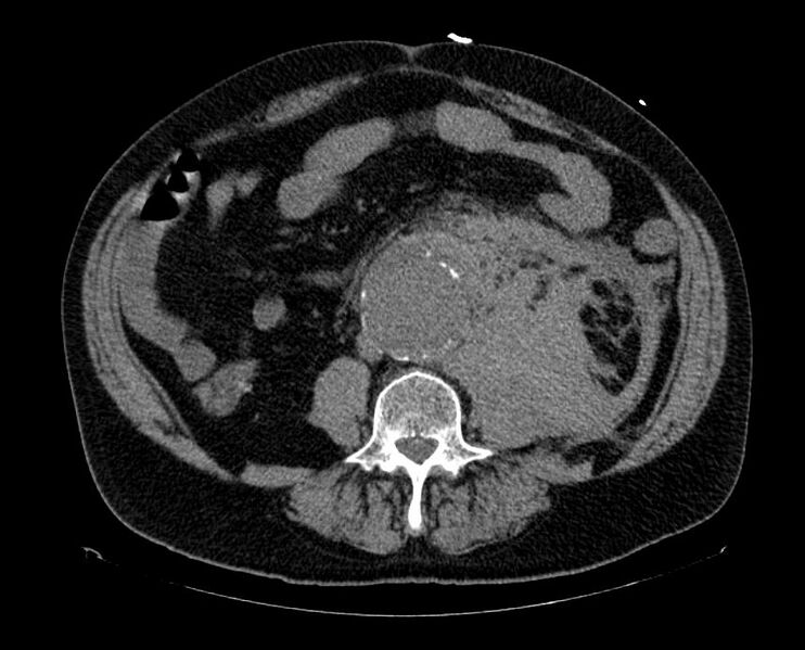 File:Abdominal aortic aneurysm rupture (Radiopaedia 11149-11514 Axial non-contrast 1).jpg