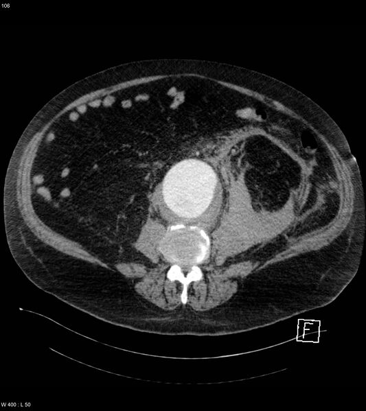 File:Abdominal aortic aneurysm with intramural hematoma then rupture (Radiopaedia 50278-55632 Axial C+ arterial phase 105).jpg