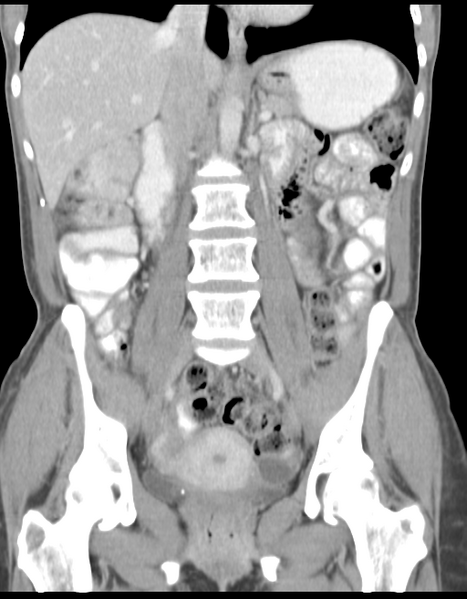 File:Abdominal desmoid tumor (Radiopaedia 41007-43740 Coronal C+ portal venous phase 22).png