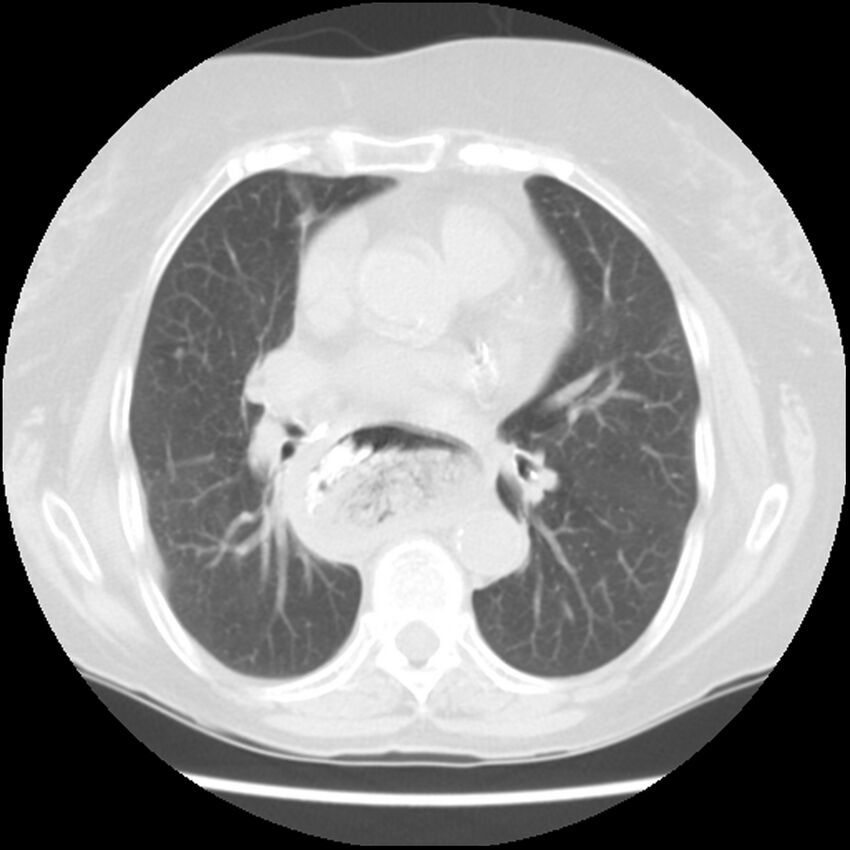 Achalasia (Radiopaedia 44094-47649 Axial lung window 31).jpg