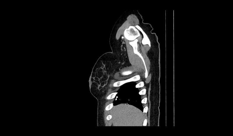 File:Acquired tracheo-esophageal fistula (Radiopaedia 51356-57103 Sagittal C+ arterial phase 18).jpg