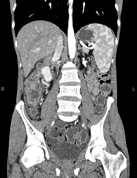 File:Active crohn disease (Radiopaedia 87133-103397 Coronal C+ arterial phase 38).jpg
