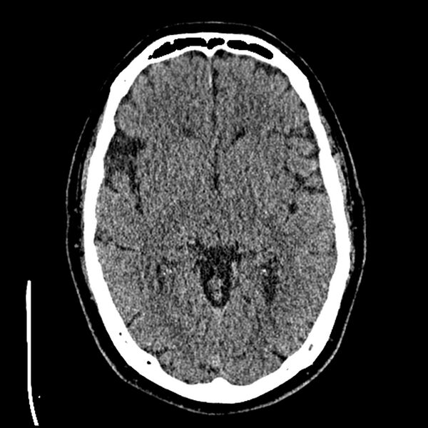 File:Acute A3 occlusion with ACA ischemic penumbra (CT perfusion) (Radiopaedia 72036-82525 Axial non-contrast thins 24).jpg