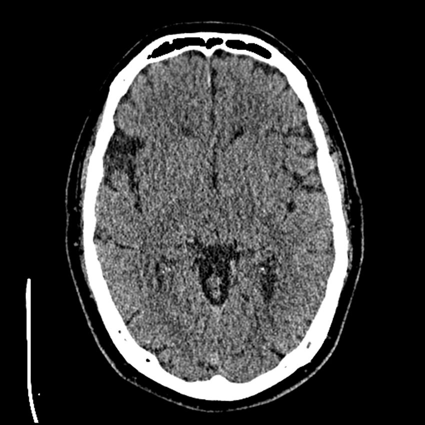 Acute A3 occlusion with ACA ischemic penumbra (CT perfusion) (Radiopaedia 72036-82525 Axial non-contrast thins 24).jpg