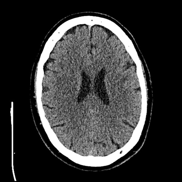 File:Acute A3 occlusion with ACA ischemic penumbra (CT perfusion) (Radiopaedia 72036-82525 Axial non-contrast thins 64).jpg