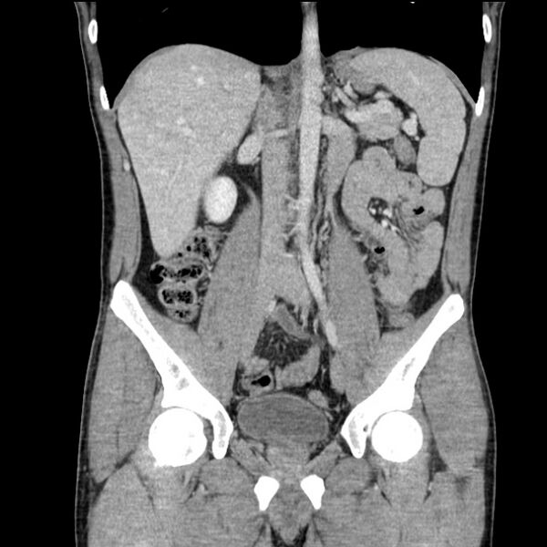 File:Acute appendicitis (Radiopaedia 27049-27227 Coronal C+ portal venous phase 29).jpg